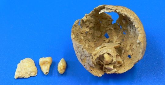 Tumor de ovario encontrado en el esqueleto de una mujer romana