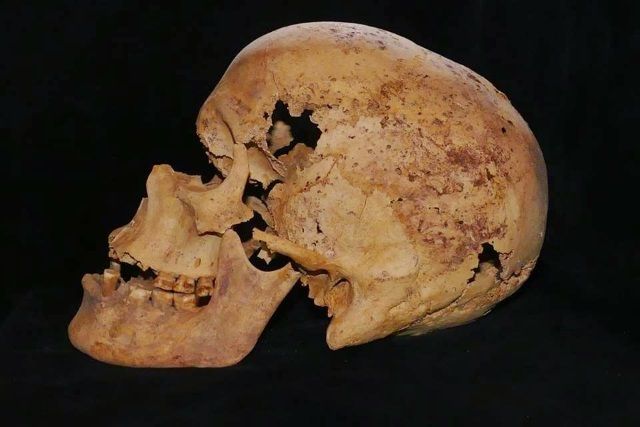 Cráneo de una mujer egipcia que muestras restos de haber padecido cáncer.