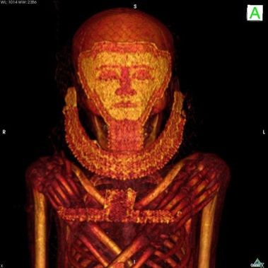 momia egipcia cancer mama