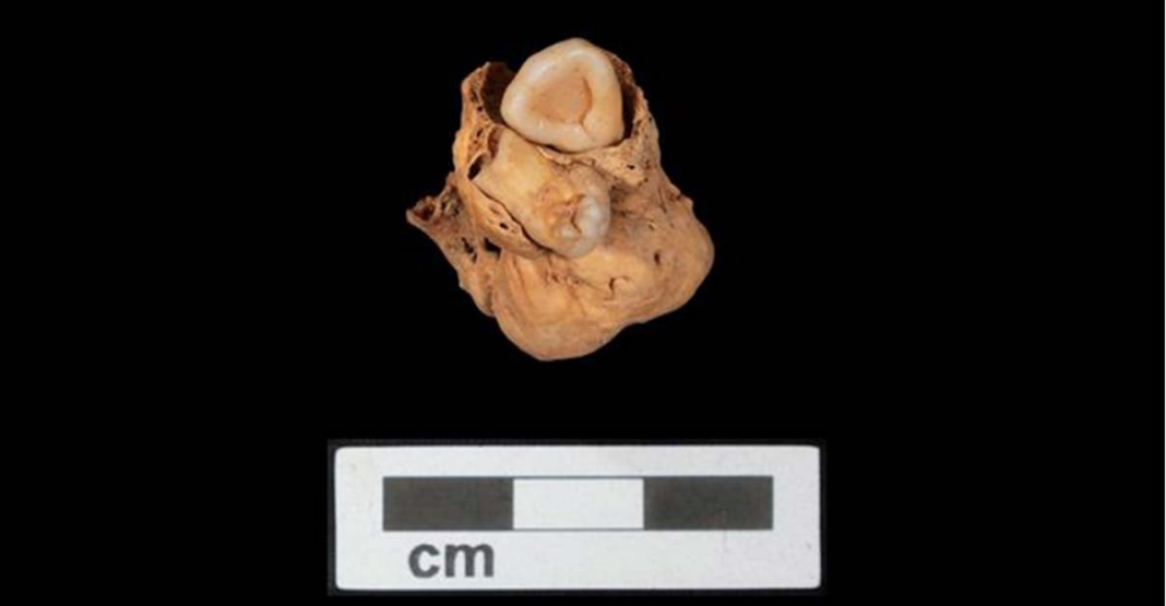 El caso de teratoma más antiguo de África.